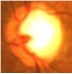 Image of an eye afflicted with glaucoma.